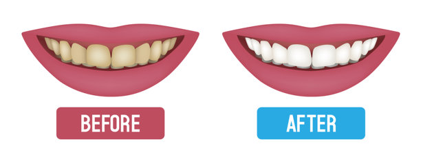 牙齿美白。前后对比。矢量图。图片下载