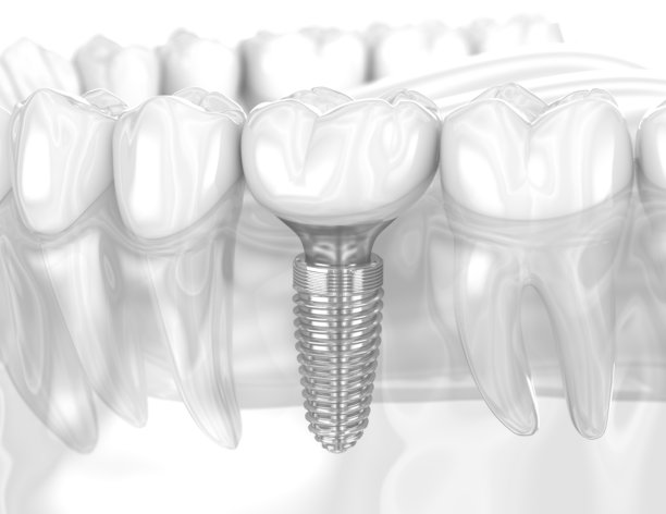 牙科植入物和陶瓷牙冠。三维插画。图片下载