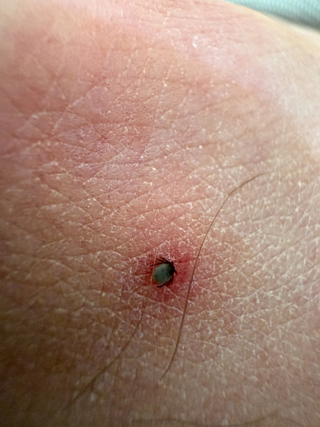 吸血蜱虫在人体皮肤上的微距照片。蓖子硬蜱。膨胀的寄生虫咬入粉红色刺激的表皮。小红点。危险的昆虫螨虫。脑炎、莱姆病感染。图片下载