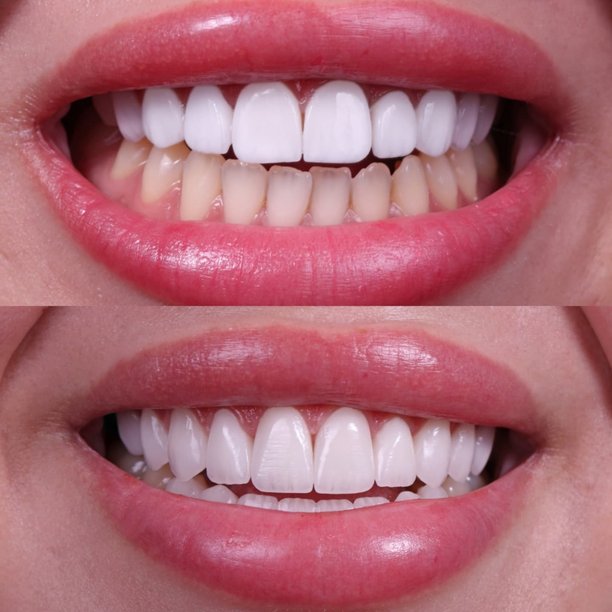 牙齿美白前后对比——女性笑容蜕变展示自然的牙齿改善图片下载