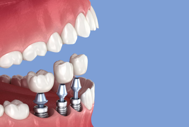 3颗种植体上牙冠的安装。牙科3D插画图片下载