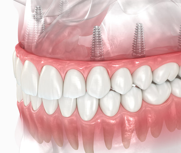 种植体支撑的全口All on 6种植义齿，附带牙龈。牙科3D插画图片下载