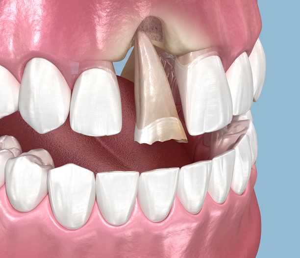 牙周炎和牙龈萎缩。3D插画图片下载