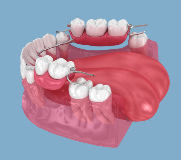 可摘局部义齿，下颌义齿。牙科修复学概念的医学精确3D插画。图片下载