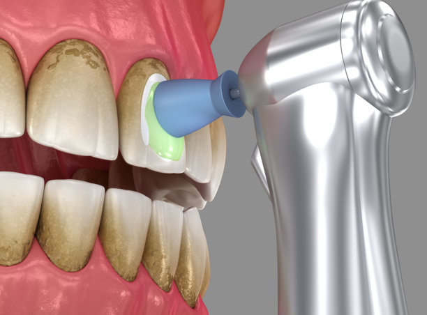 使用专业牙刷和凝胶进行的牙齿抛光程序。牙科3D插画图片下载