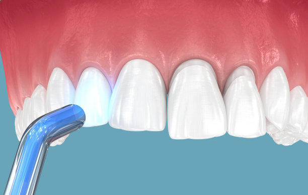 使用聚合灯固定牙齿贴面。牙科3D插画图片下载