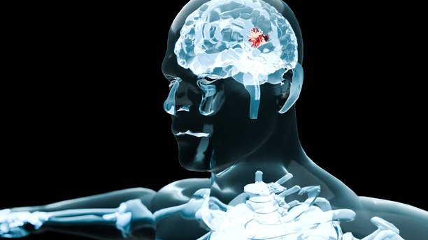 脑癌，X光，脑肿瘤，癌症生长，肿瘤生长，3D渲染医学动画，脑癌可视化，3D动画，高质量4K素材图片下载