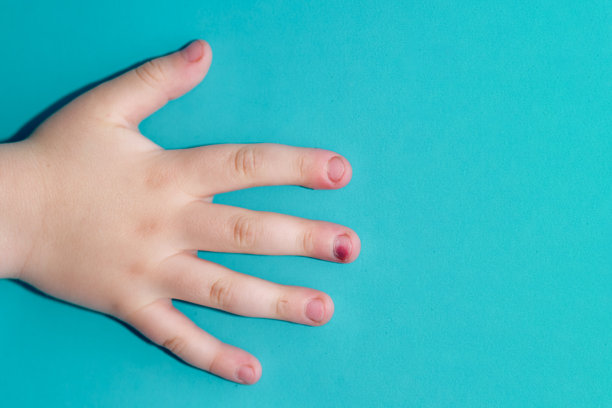 儿童带伤指的 the hand, 复制空间。健康问题。蓝色背景上的手指受伤，有复制空间。指甲创伤。4岁儿童（四岁）。图片下载