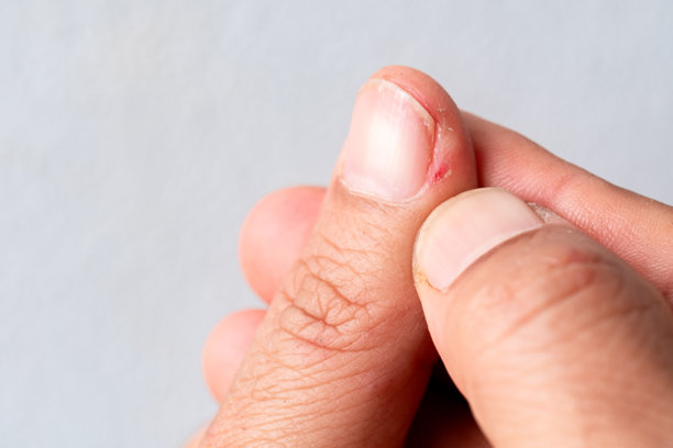 指甲周围发红伴有轻微伤口，显示指甲感染、倒刺刺激或甲沟炎。医疗健康概念，皮肤问题细节。微距照片图片下载
