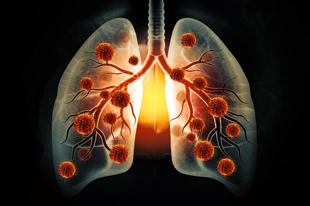 医学背景下的肺癌或支气管癌的医学插图，3D插画图片下载
