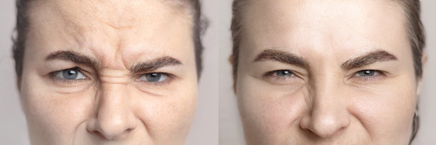 拼贴画，包含高加索女性的肖像，鼻梁和眉间有皱纹，以及美容师后的肖像。肉毒杆菌注射，Dysport。皮肤褶皱。特写照片。图片下载