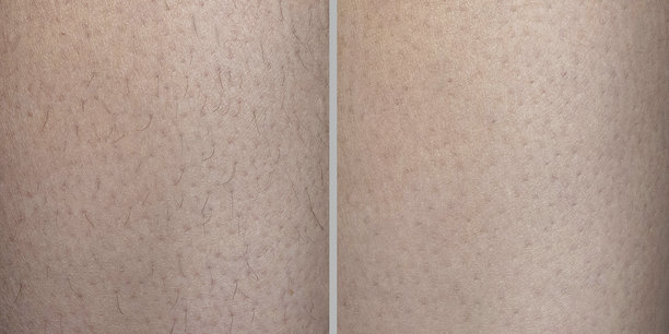 脱毛前后对比拼贴照片。脱毛概念的图像前后对比。特写宏观照片图片下载