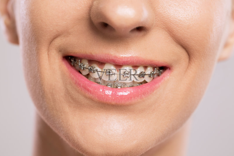 带牙套的健康微笑正版图片素材