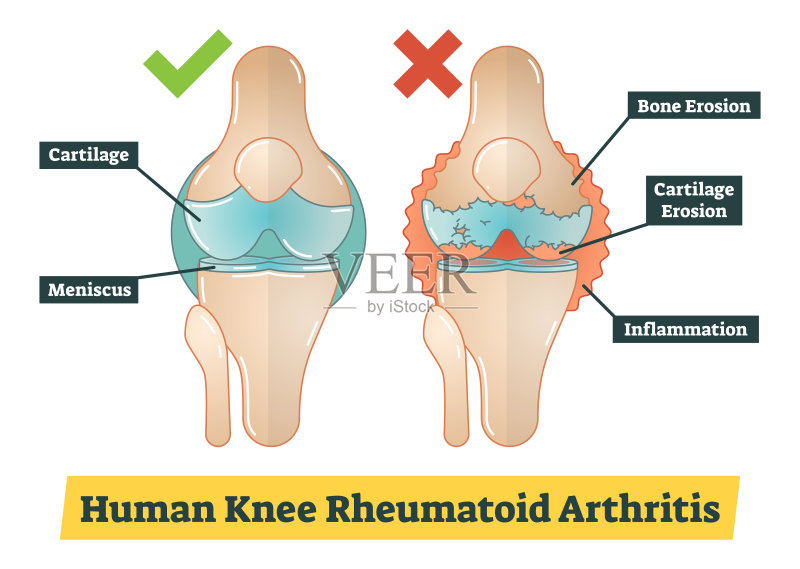 类风湿性关节炎正版插画素材