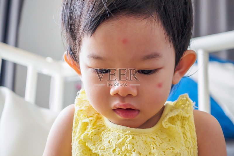 可爱的亚洲小女孩因昆虫叮咬引起的面部过敏红斑正版图片素材