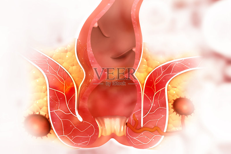 痔疮(痔疮)的科学背景正版插画素材